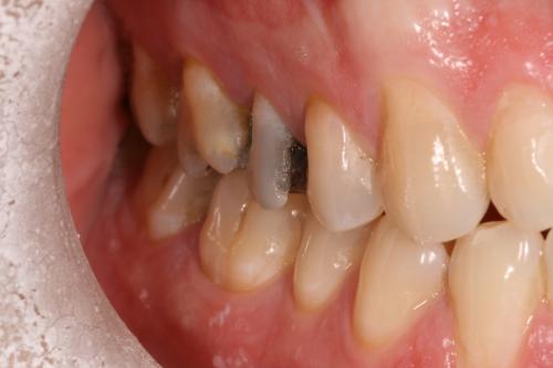 Porcelain crowns before