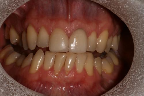 Porcelain veneers and teeth whitening before