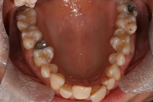 Invisalign straightening before