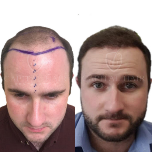 FUT hair transplant
