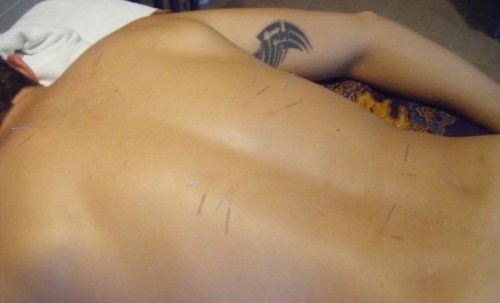Acupuncture back treatment
