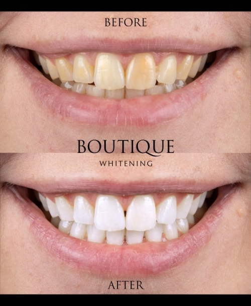 boutique teeth whitening