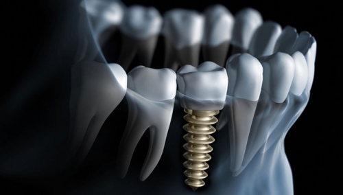 Dental Implant for 500 euro