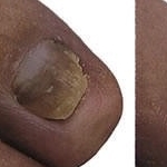 Fungal nail in need of nail reconstruction