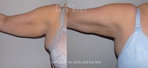 Marlow Face Body Cooltech 2